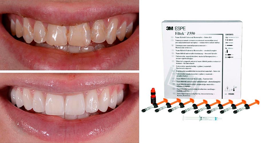 3M ESPE сделали первые шаги в направлении эстетической реставрации зубного ряда